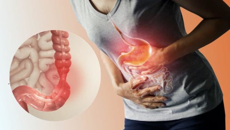 sindrome colon irritabile