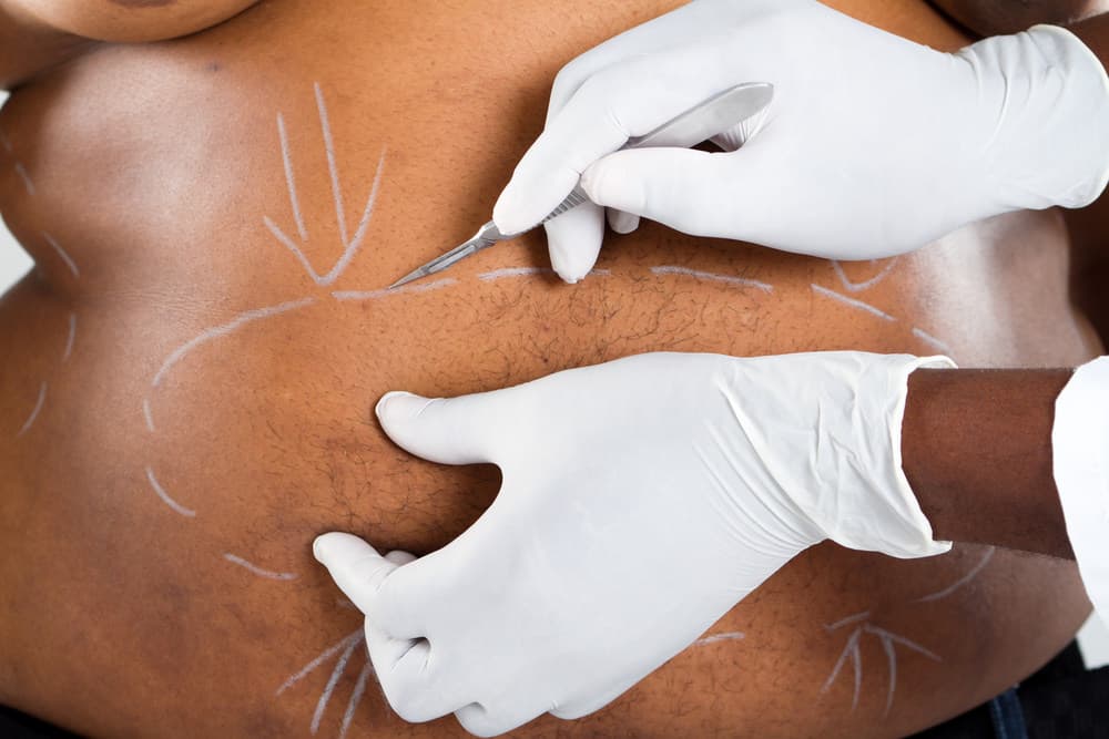 Obesità e chirurgia bariatrica