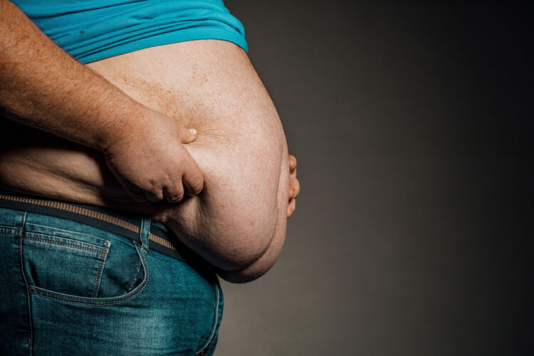 Obesità: cos'è, cause e perché non dipende solo dalla volontà